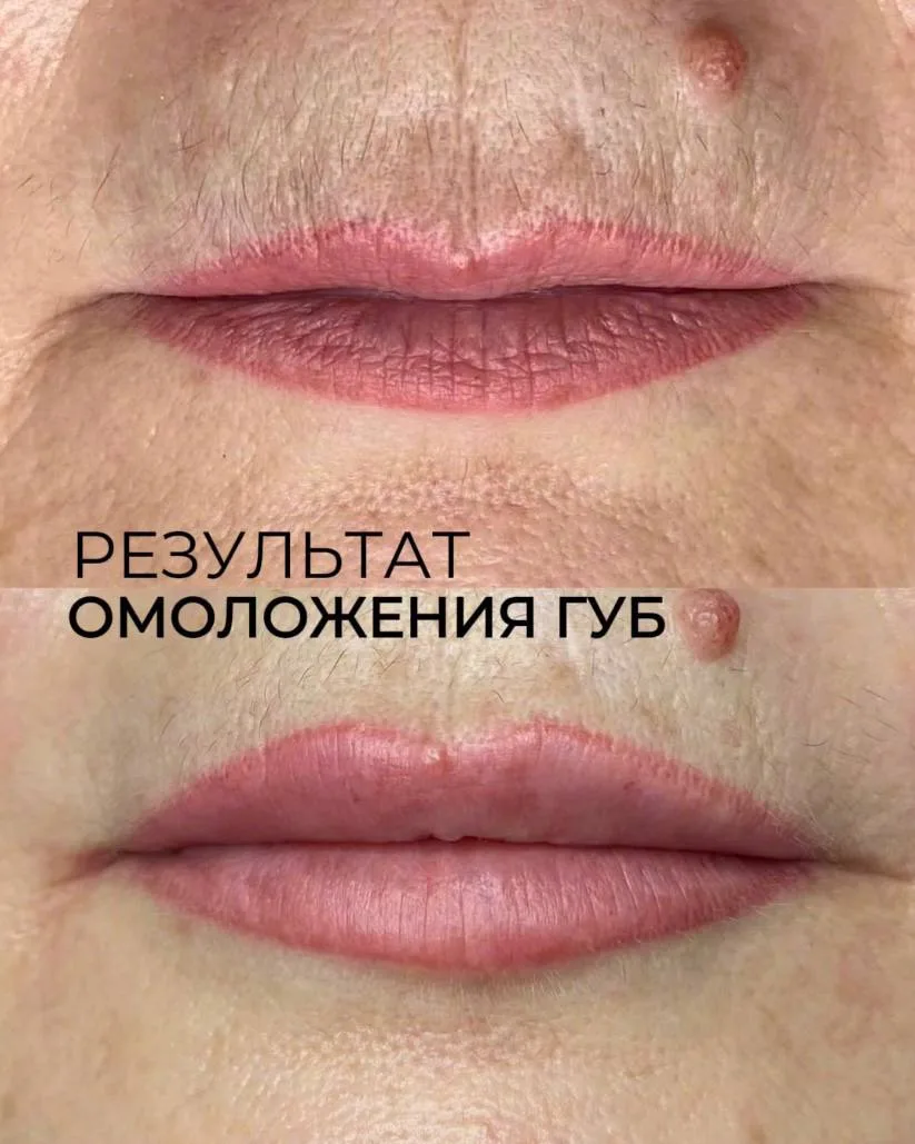 Как вы считаете, нужно омолаживать губы? Или лучше оставить как есть?