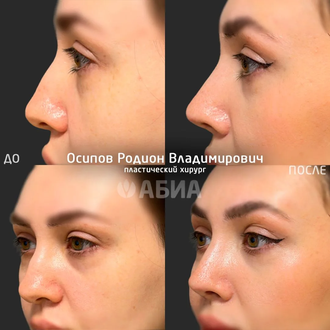 Новый взгляд на себя — через месяц после риносептопластики
