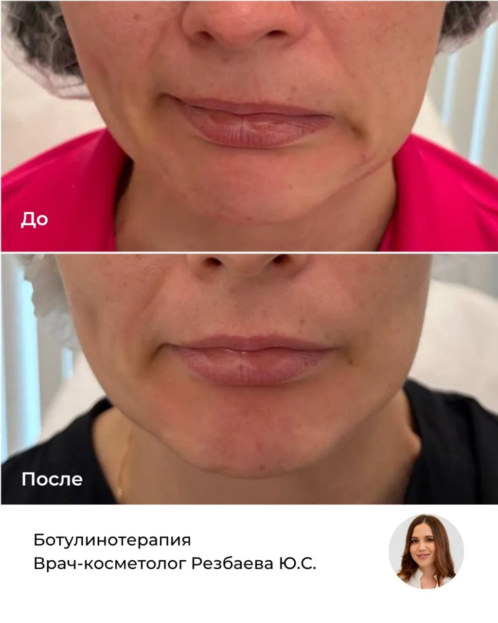 Ботулинотерапия — это не всегда про разглаживание морщин.