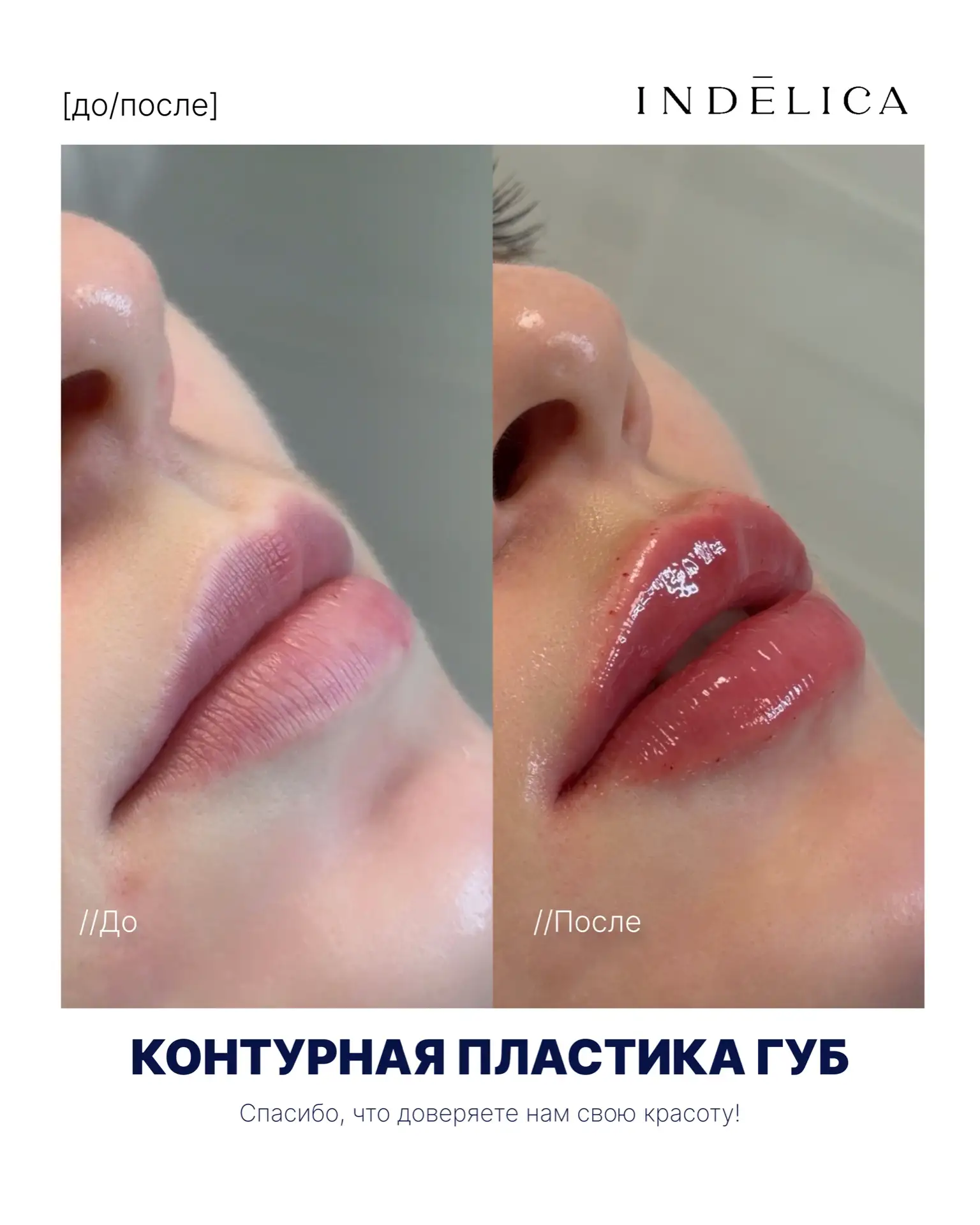 «Сделать губы» и «вернуть губам жизнь» — это две разные процедуры. Мы про вторую 😍