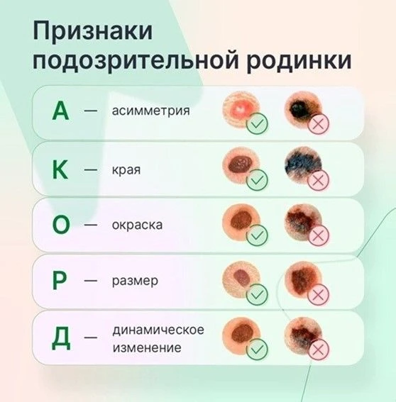 Симптомы меланомы (Правило ABCDE)^