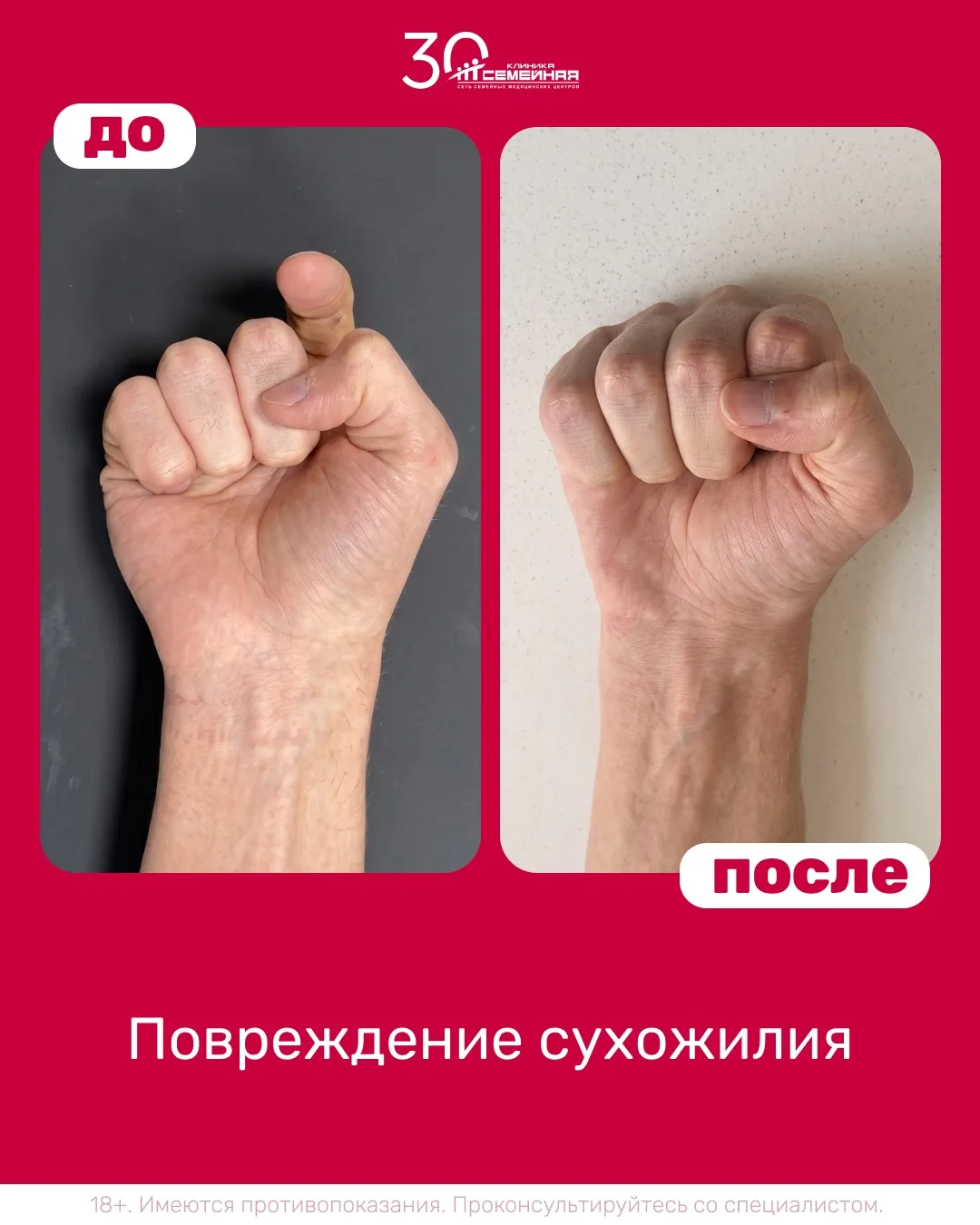 🖐 Оперативное лечение повреждения сухожилия