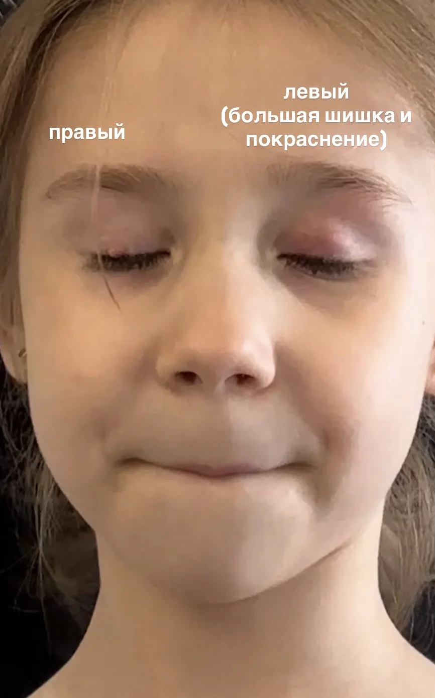 Вот смотрите. У меня остались вопросы. Блин сама виновата, что не поехала. На правом глазу он ставит