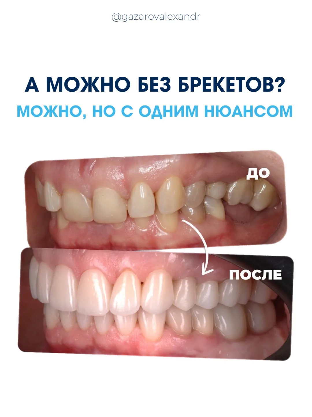 Можно без брекетов? 
Можно, но с одним нюансом 

Смотрите разбор интересного клинического случая в к