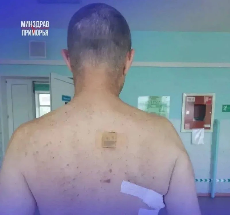 С ножом в спине: приморские врачи вытащили мужчину с того света.  Житель Покровки поступил в Октябрь