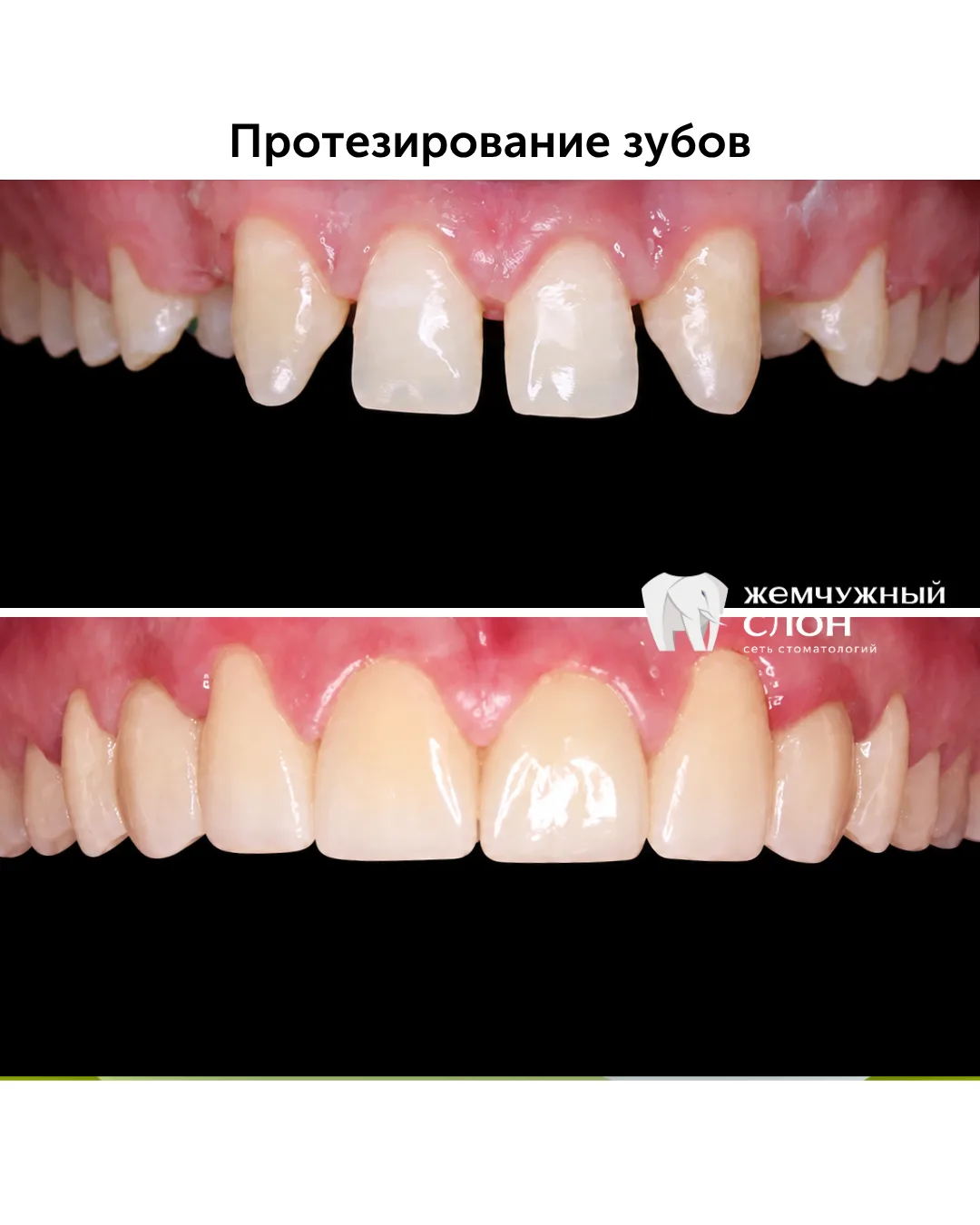 Для красивого и, главное, долговечного результата сначала было проведено ортодонтическо...