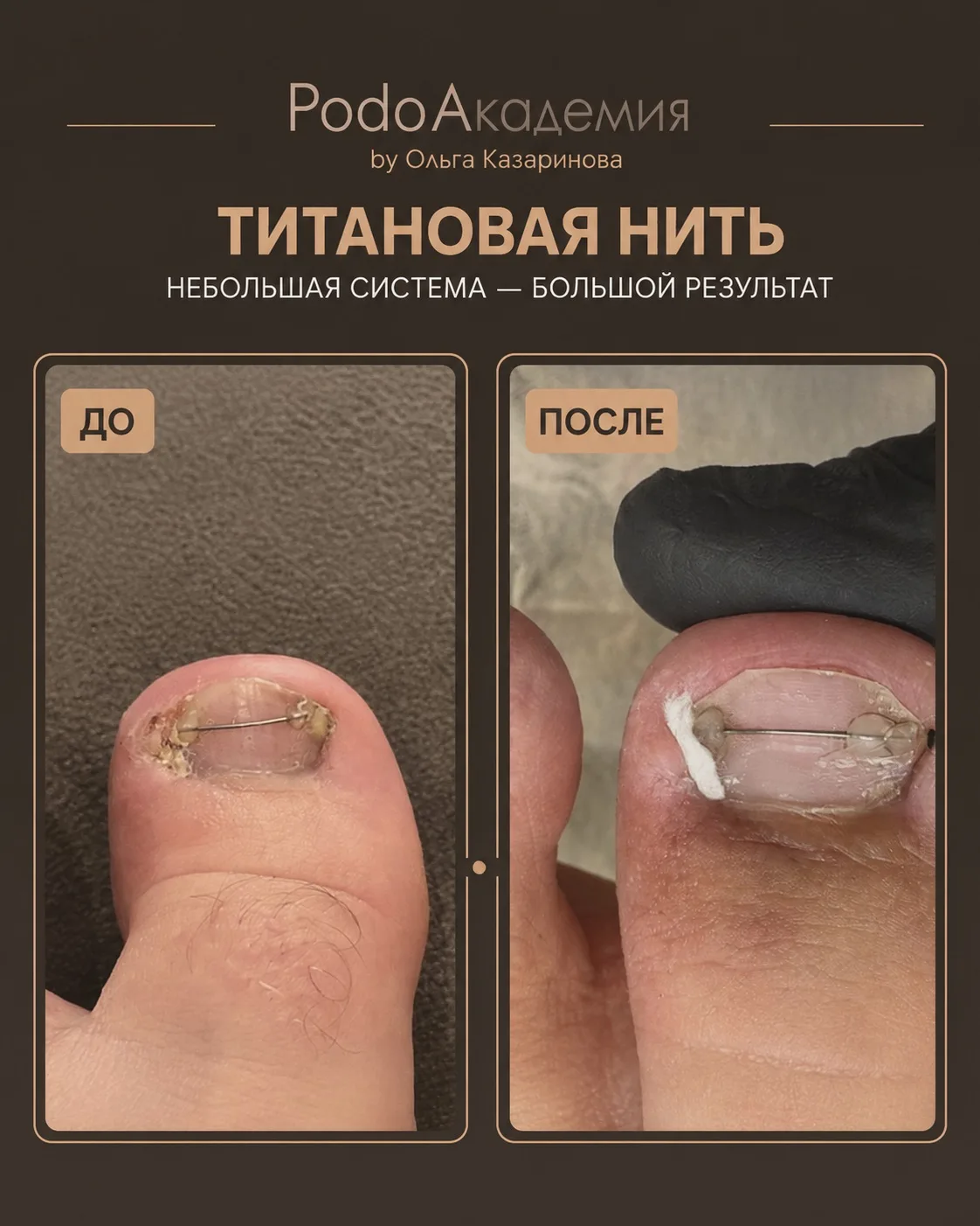 С чего начинать знакомство с коррекционными системами? Я бы начала с титановой нити. По...