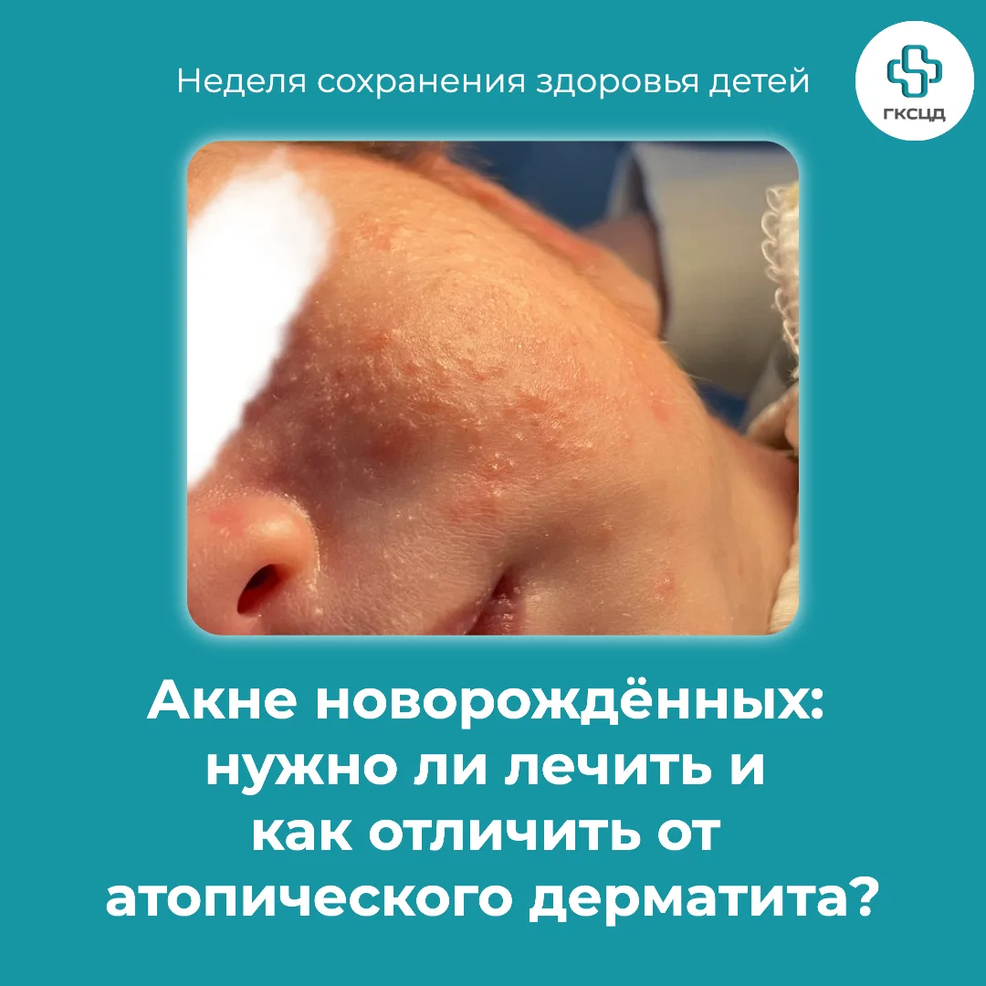 Акне новорождённых: нужно ли лечить и как отличить от атопического дерматита?