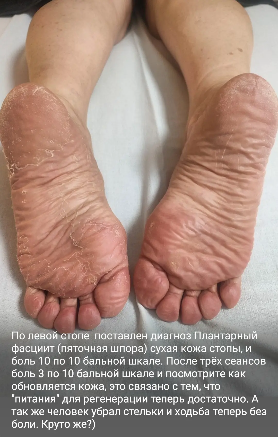 Пришла женщина, 60+. Диагноз от врача —  пяточная шпора ( плантарный фасциит) .  Боль п...