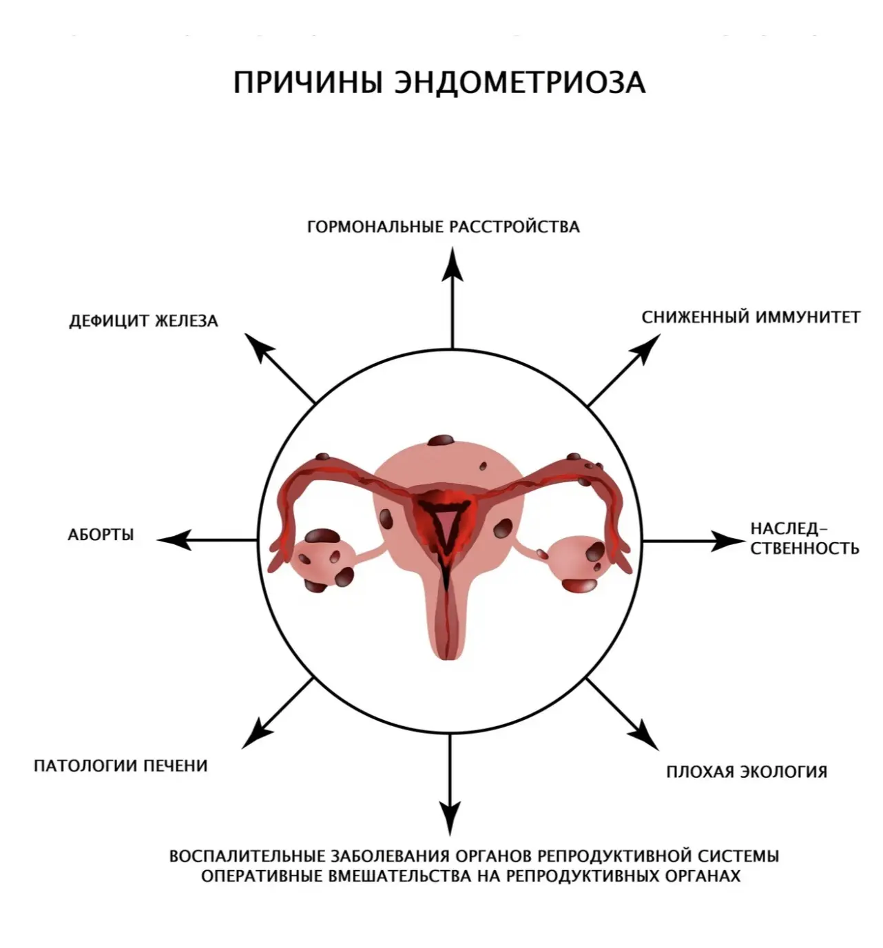 Причины, способствующих развитию эндометриоза, выделяют:

▶️ Дисбаланс гормонов, в частности, повыше