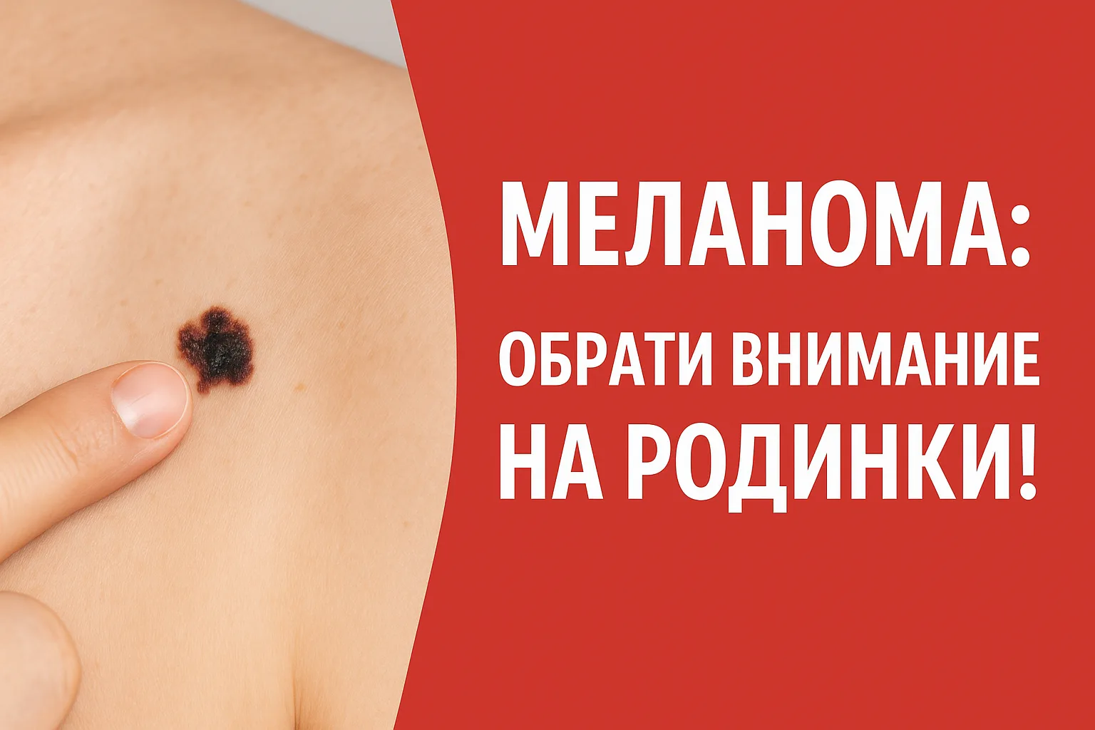 💢Рак кожи. Меланома