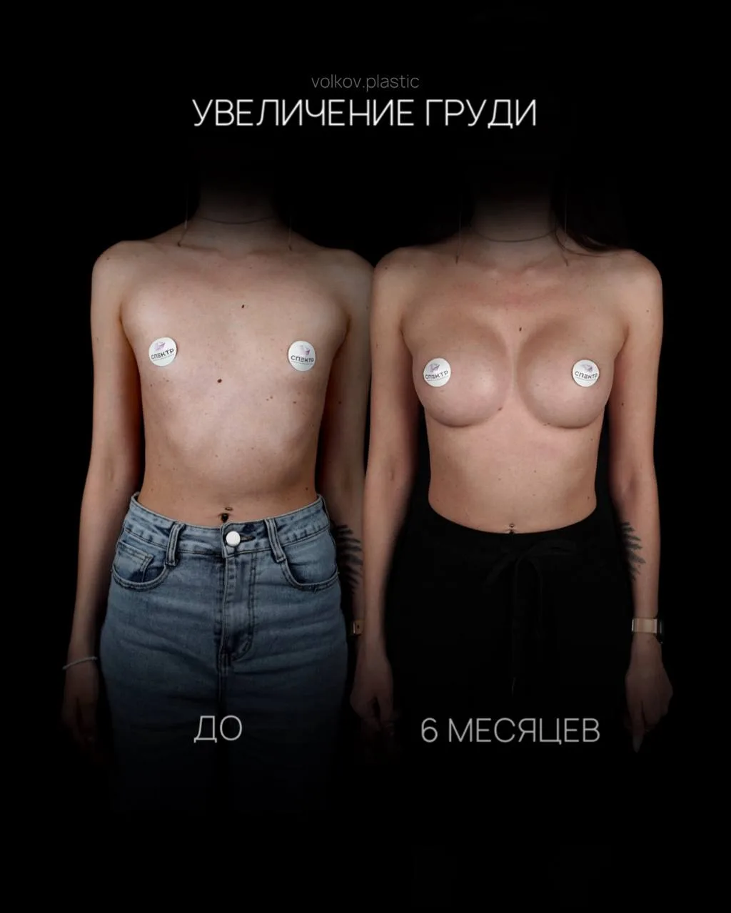 Тот самый случай, когда даже круглые импланты могут выглядеть максимально естественно и гармонично �