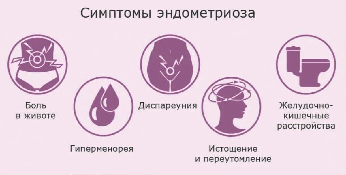 Основные симптомы эндометриоза:

▶️ Интенсивные болевые ощущения, проявляющиеся как во время менстру