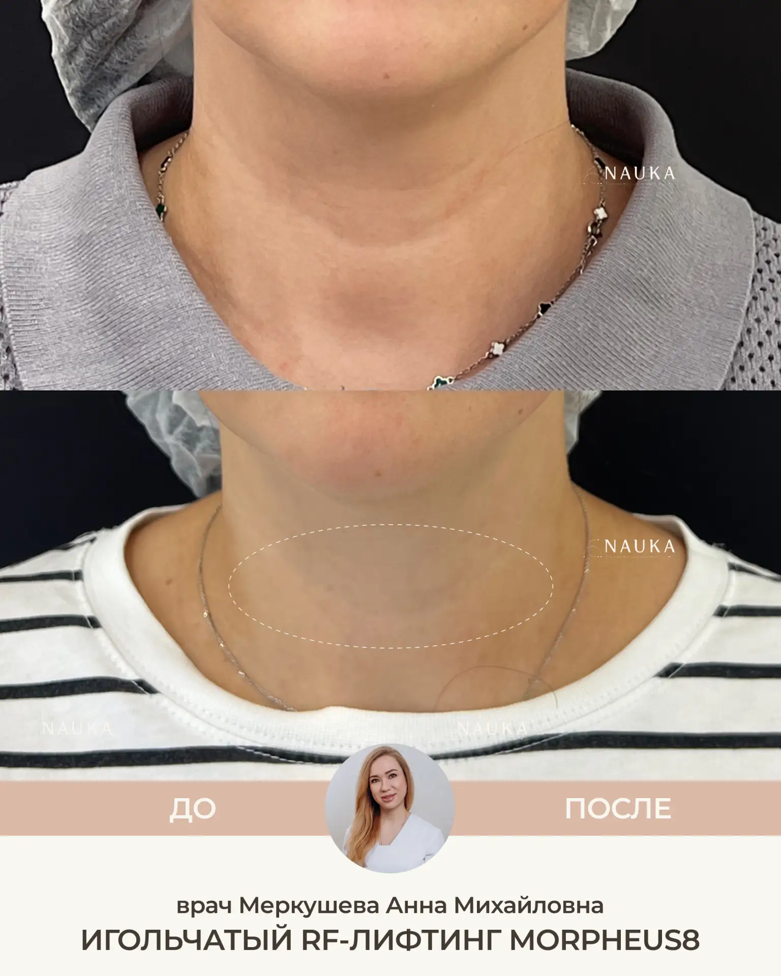 Шея, живот, руки, локти - зоны, с которыми тоже можно работать с помощью игольчатого RF...