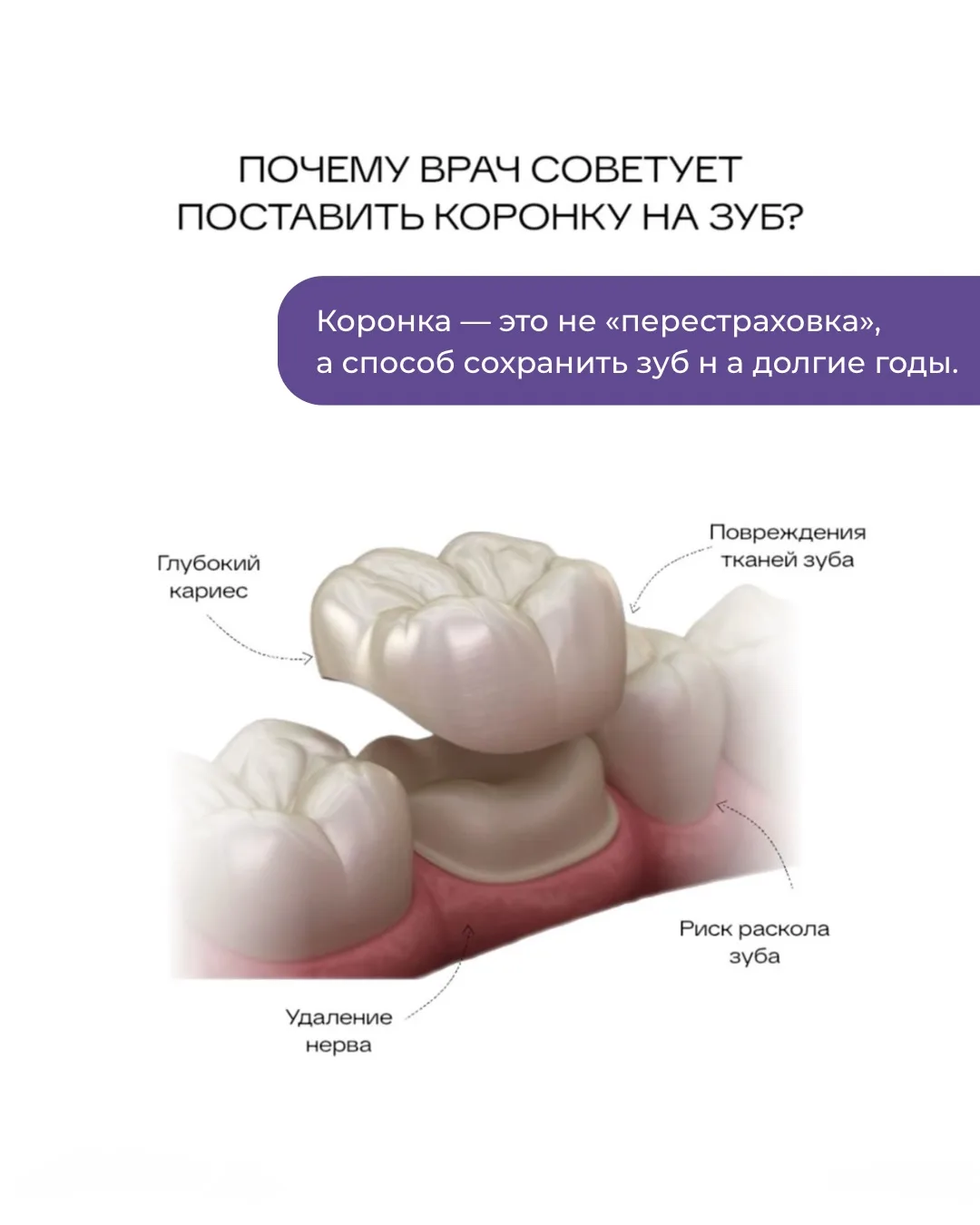 «Зачем мне коронка, если зуб ещё можно восстановить пломбой?»