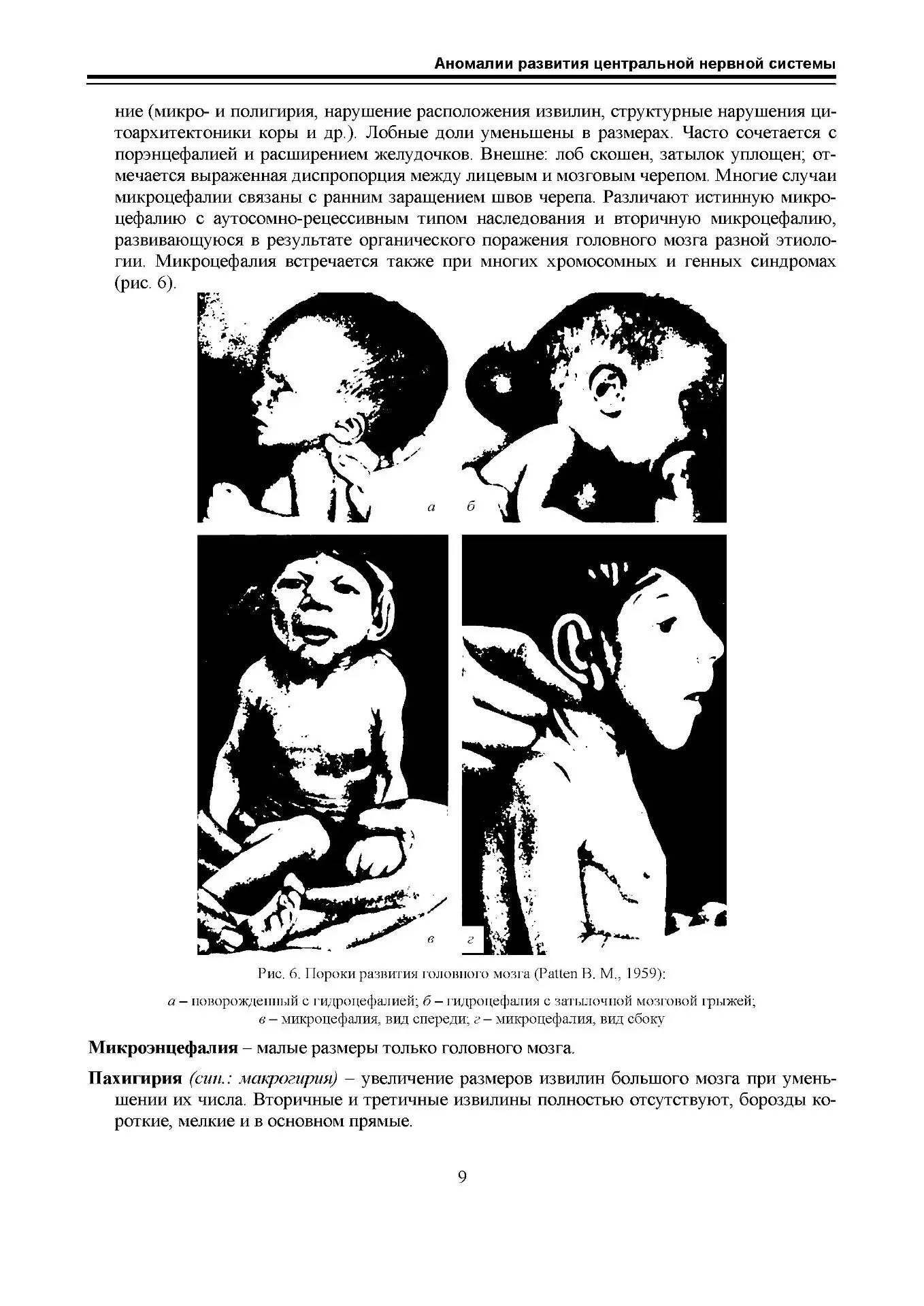 Аномалии развития ЦНС
