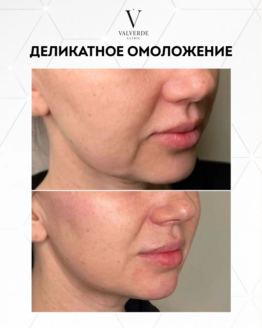 Провели деликатное омоложение для нашей пациентки💫