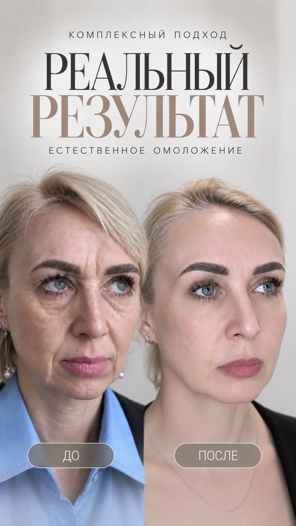 Посмотрите на ДО и ПОСЛЕ. Здесь не меняли лицо — здесь работали с возрастными изменениями.