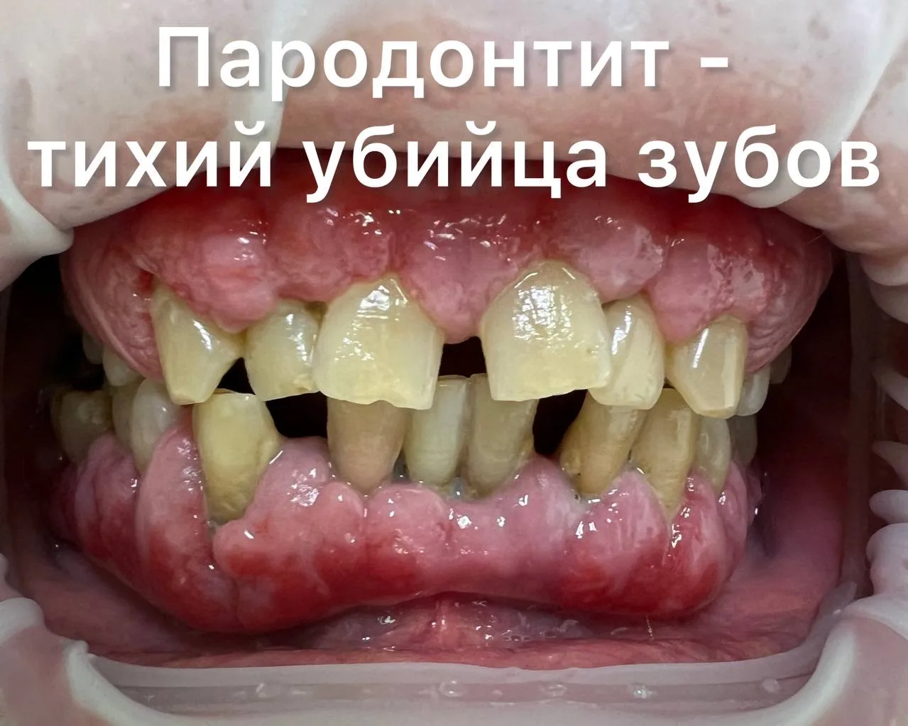Пародонтит — одно из самых распространённых хронических заболеваний в мире. По данным к...