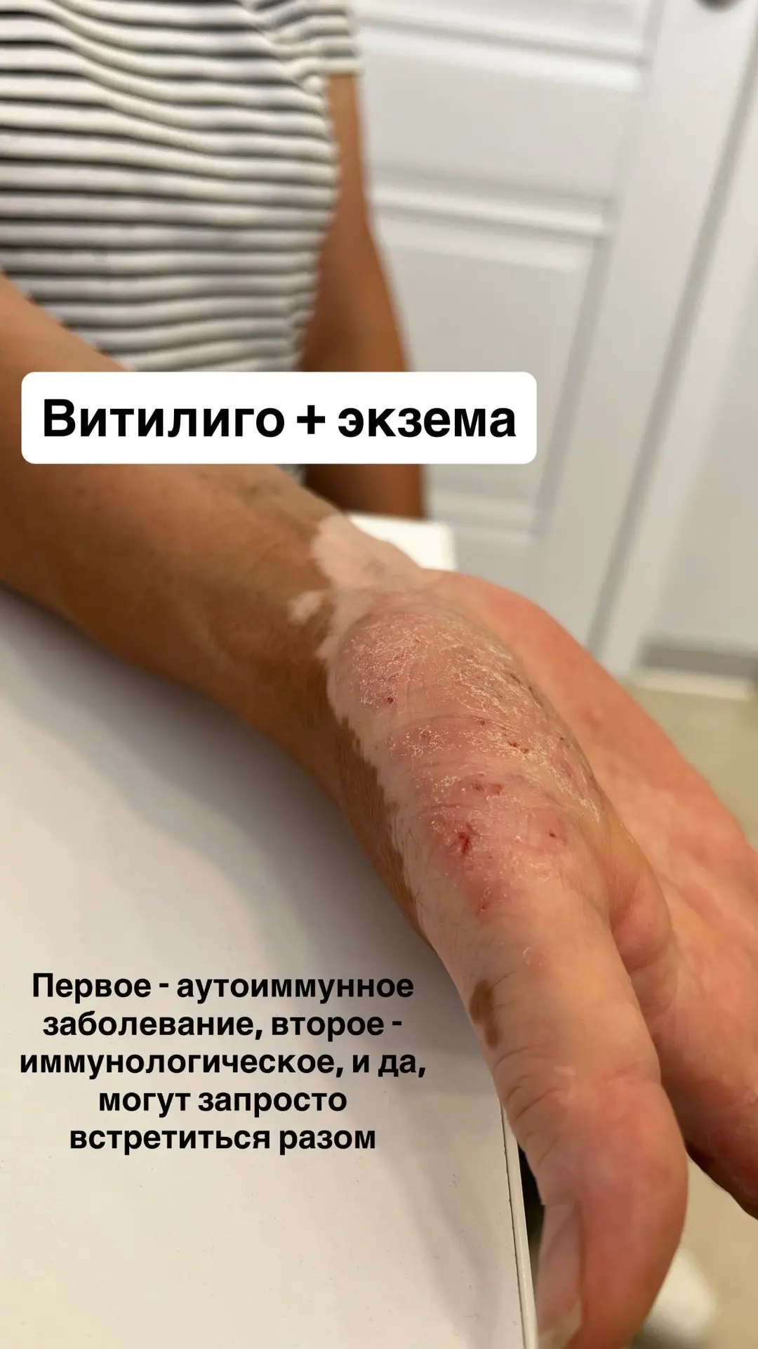Витилиго с экземой