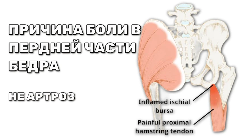 Боль в передней части бедра, около тазобедренного сустава.  • Боль в передней части бедра около тазо