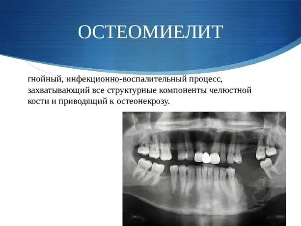 1. Альвеолит («сухая лунка»)