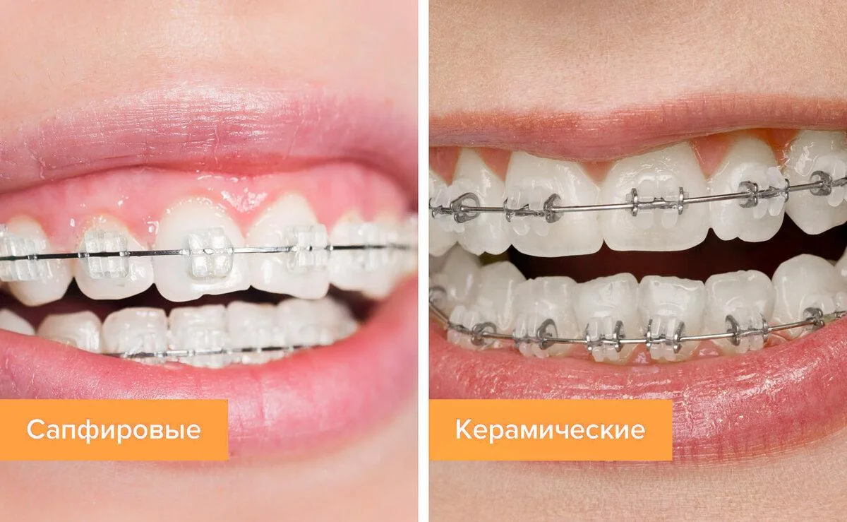 👑 Сапфировые и керамические брекеты