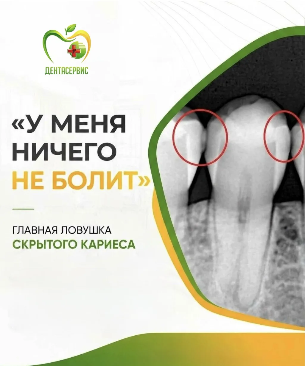 «У меня ничего не болит» — главная ловушка скрытого кариеса.