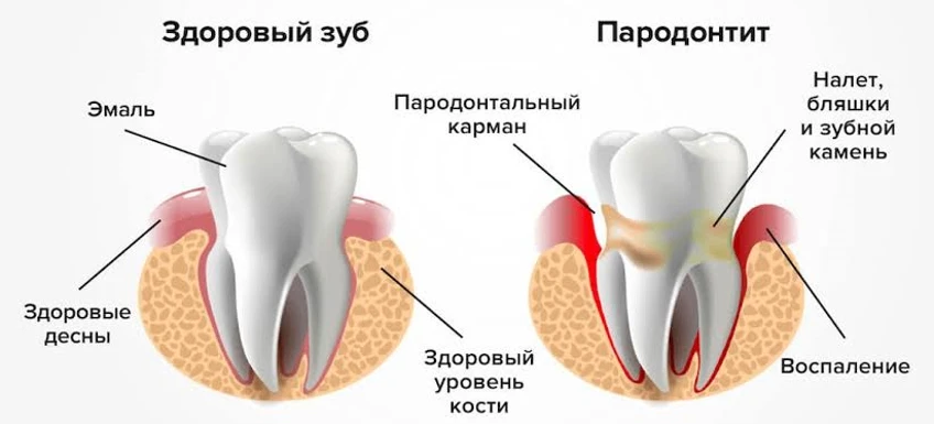 Пародонтит — враг, которого нужно знать в лицо