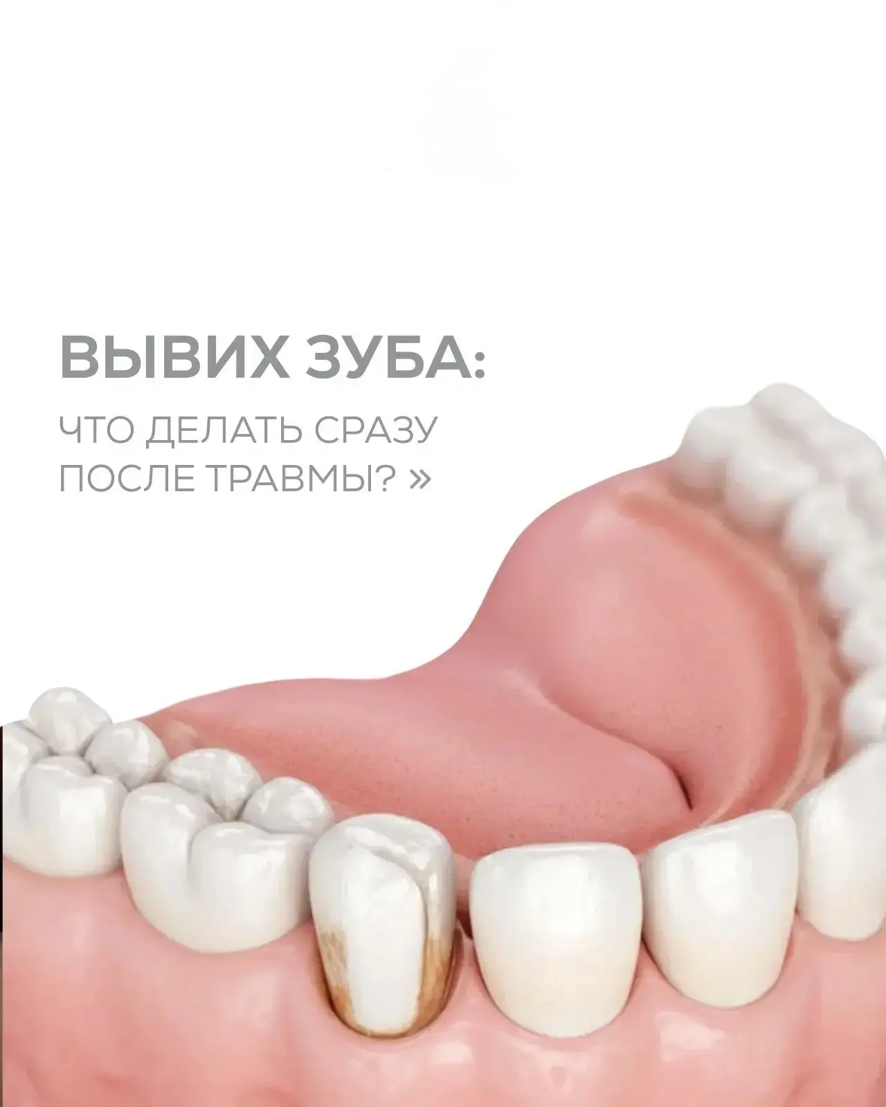 🦷 Что делать, если ребёнок выбил зуб: инструкция для родителей 🦷

Сохраняйте этот пост — он может 
