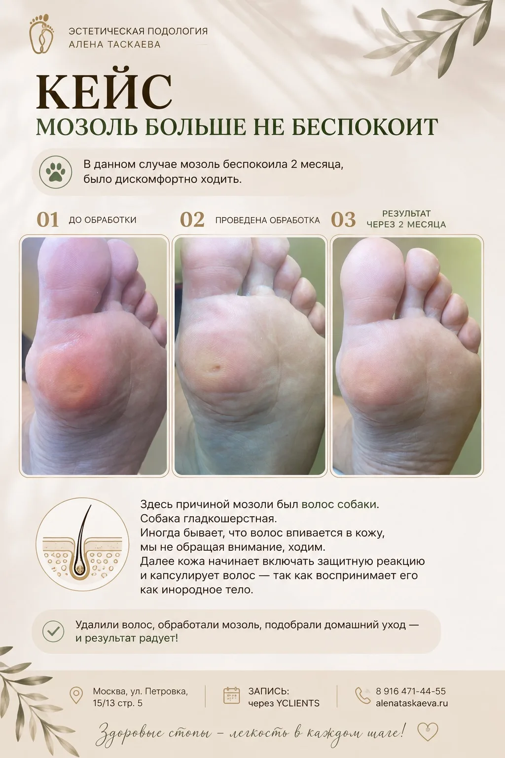 Почему мозоль появляется снова, даже если её хорошо обработали? 👣
