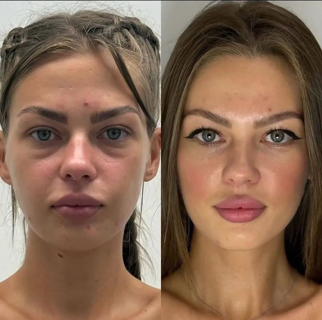 Девочки,здесь проведены 2 процедуры ❤️
Ботокс «Full Face»-7500,вместо 14000
Губы+носогубная складка-