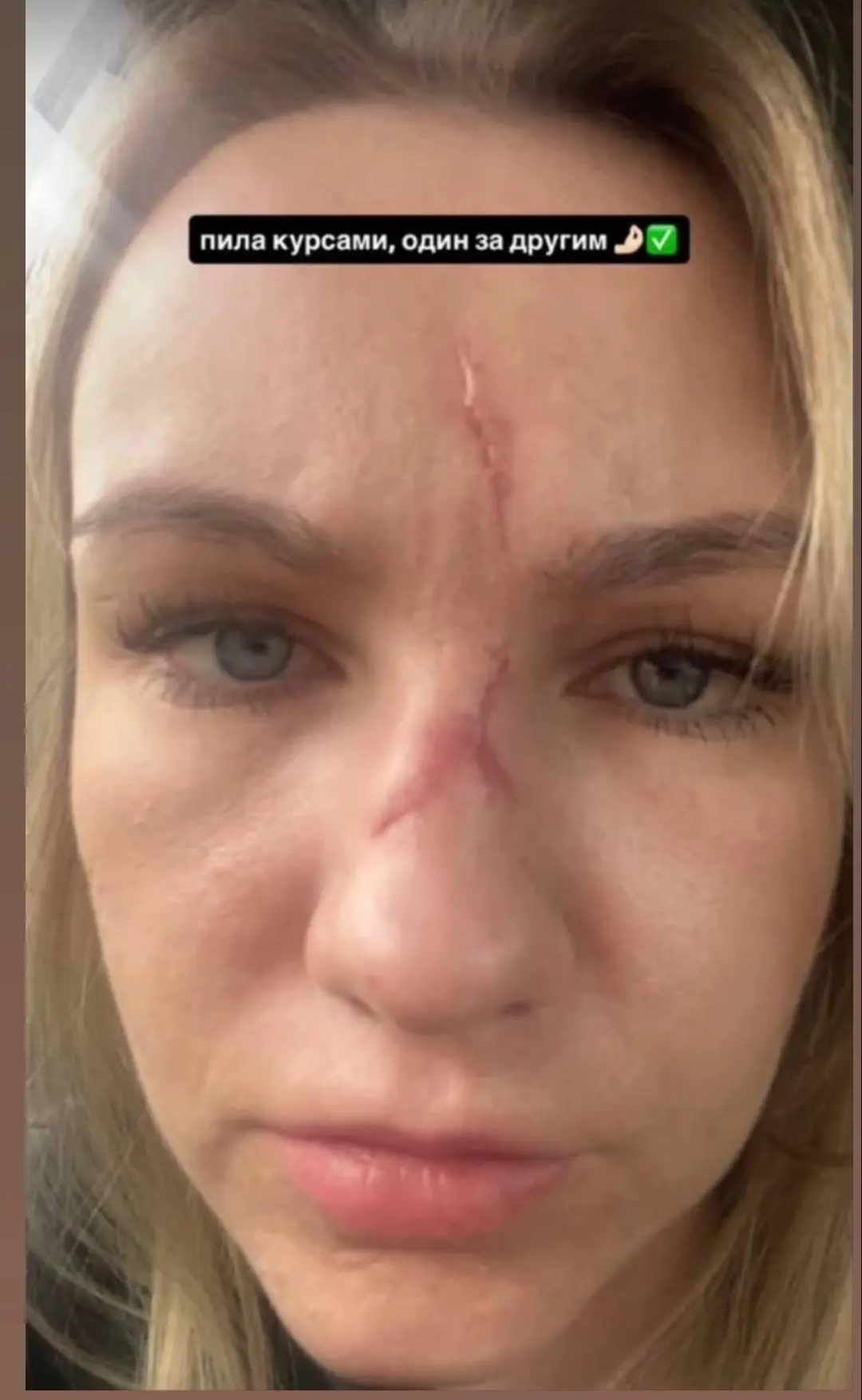 Вонзилось стекло и остались такие шрамы 😭😭😭😭
