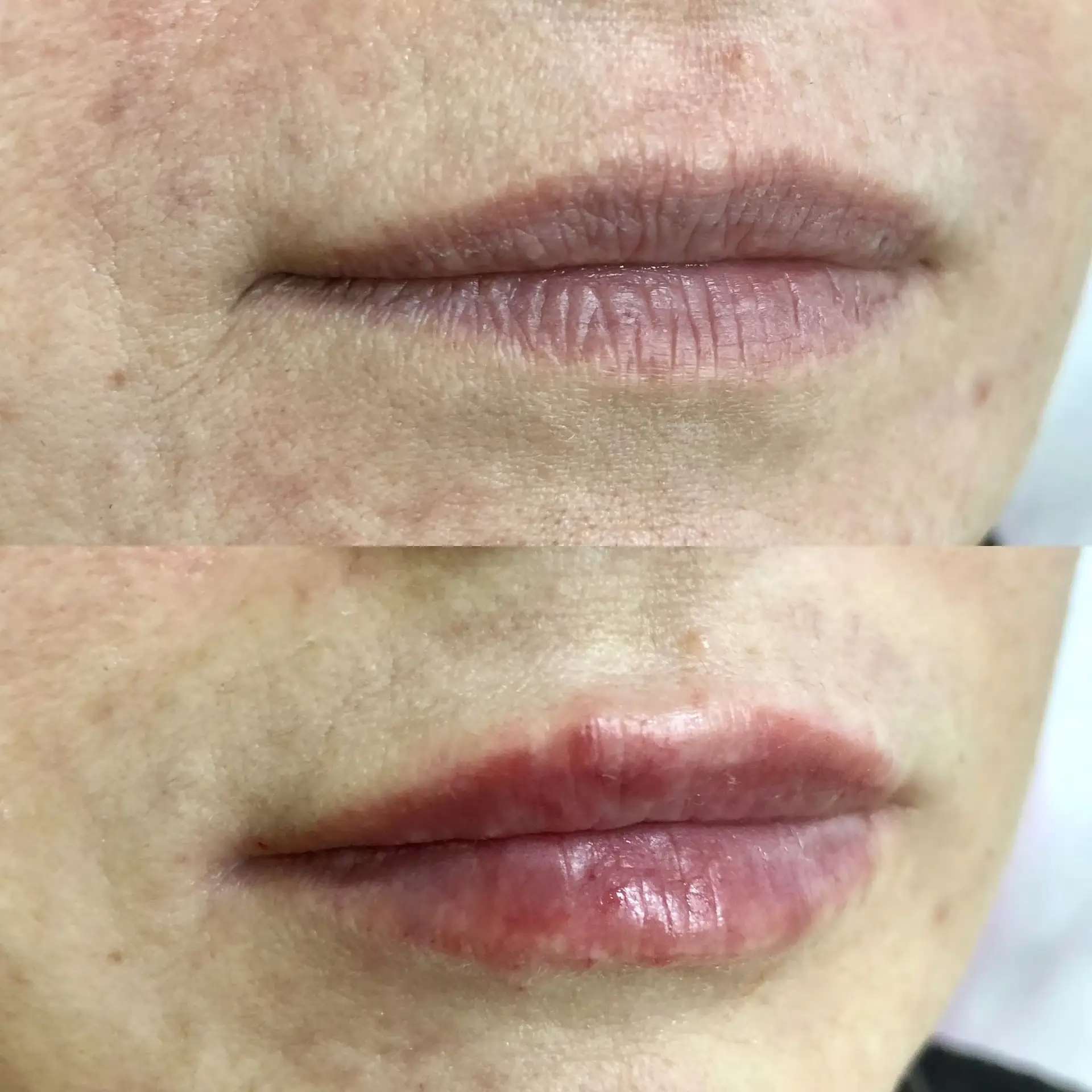 Контурная пластика губ до/ после 💋