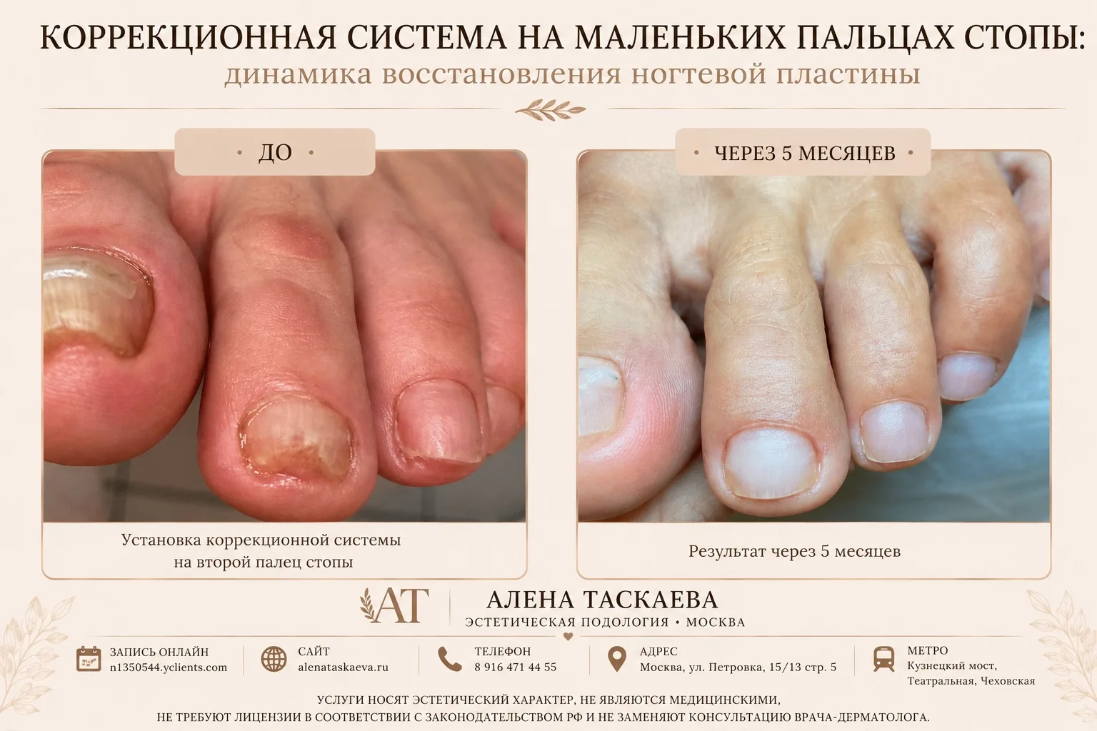 А на маленькие пальцы на стопе коррекционную систему поставить можно? 👣