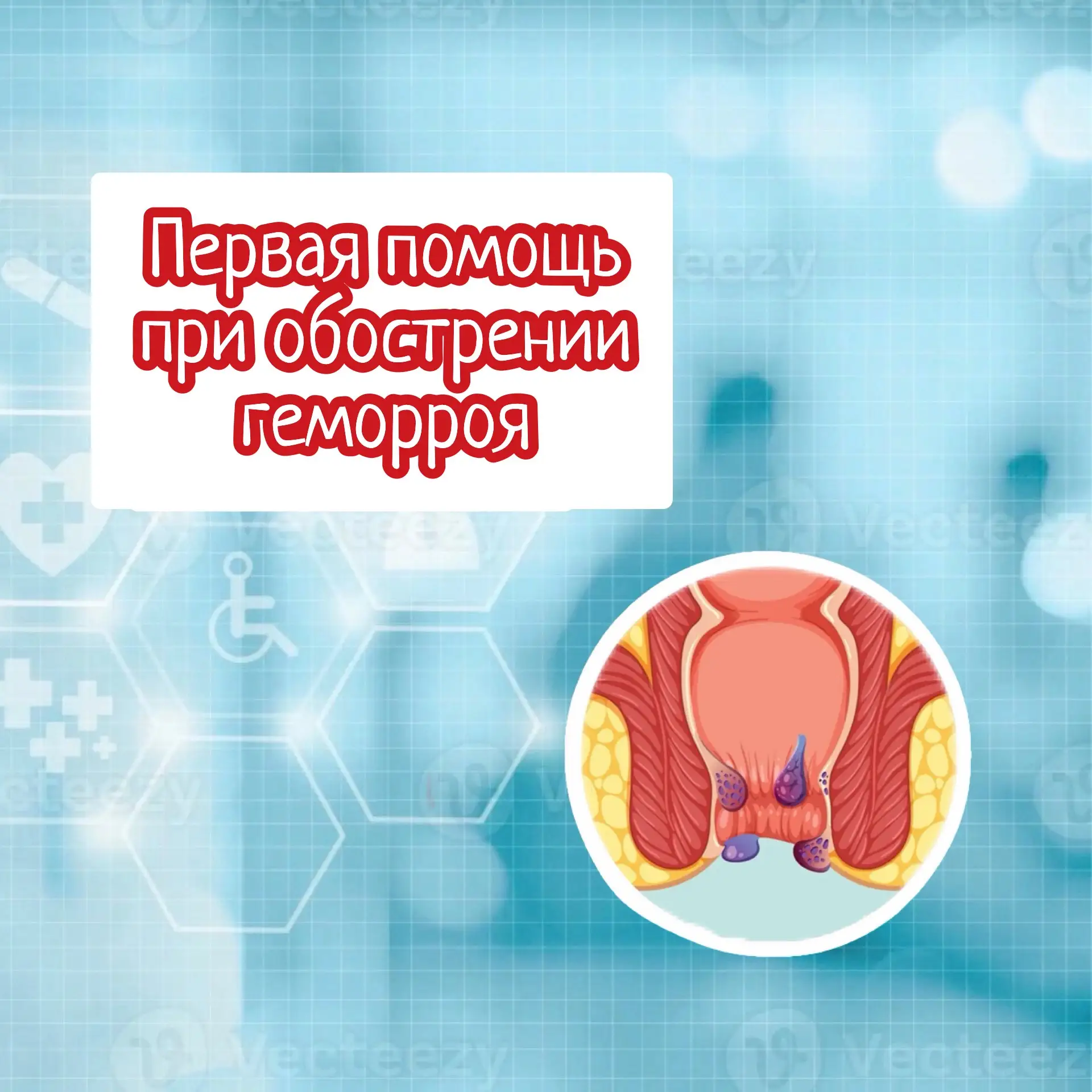 Первая помощь при обострении ГЕМОРРОЯ