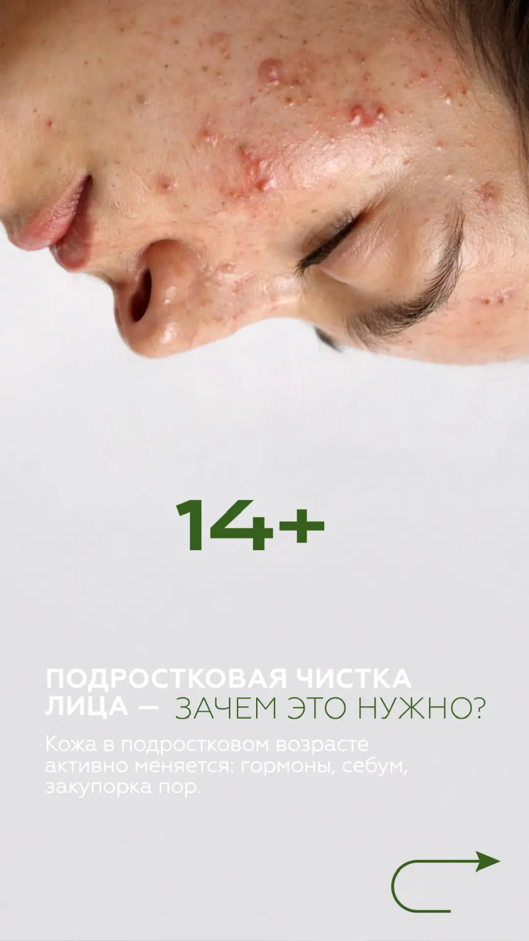 Подростковая кожа требует особого ухода, особенно когда гормоны провоцируют появление п...