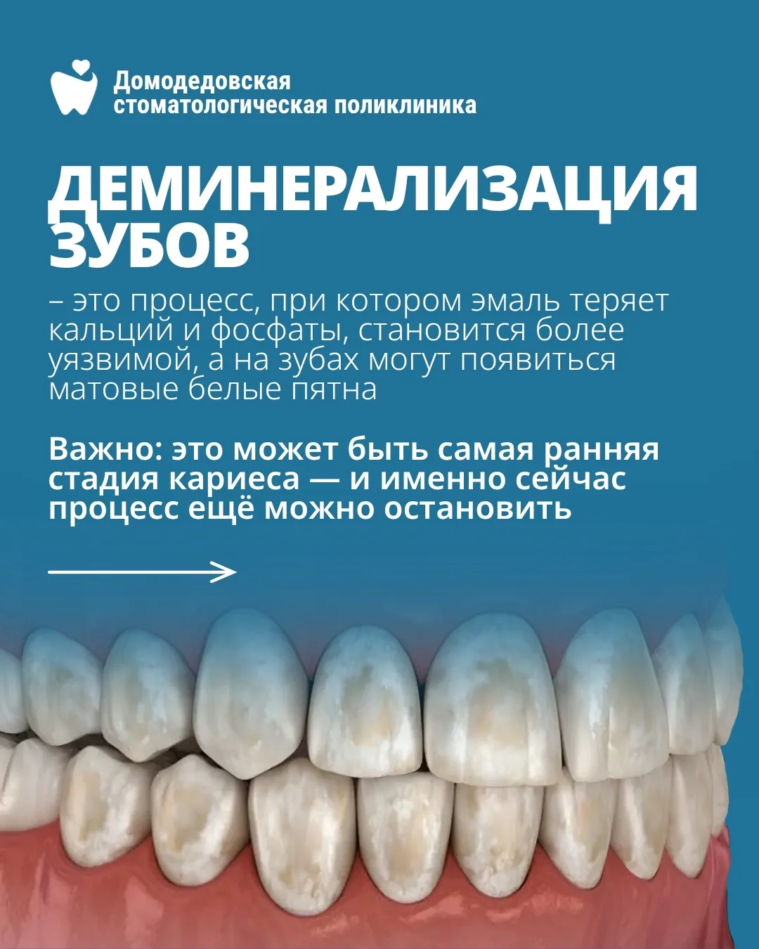 🦷Белое пятно на зубе — это просто особенность эмали или первый сигнал кариеса?