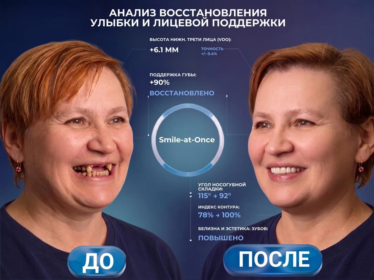 Неудобные съемные протезы в прошлом! Как имплантация подарила Валентине новую счастливу...