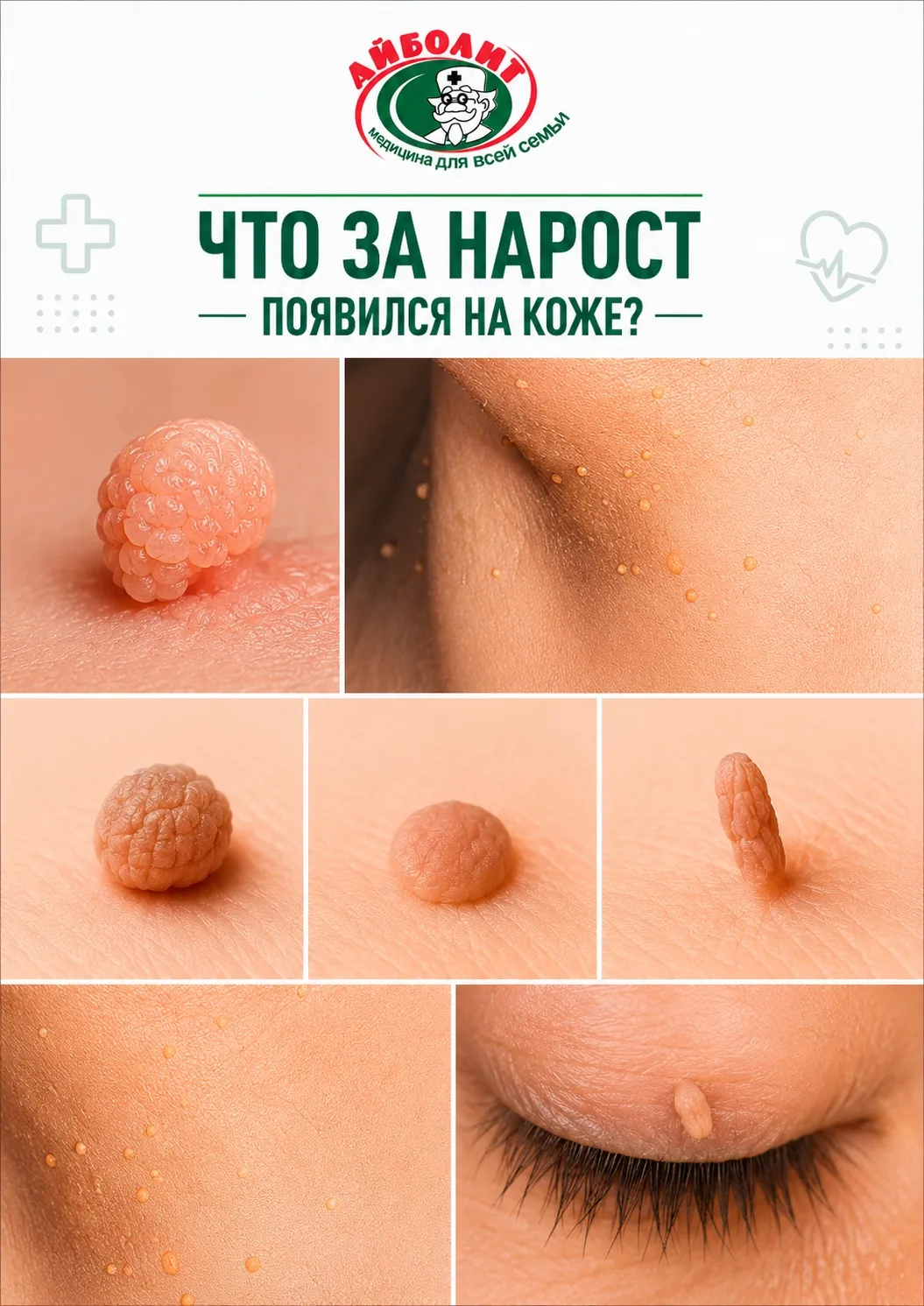 Что за нарост появился на коже? И как от него избавиться?