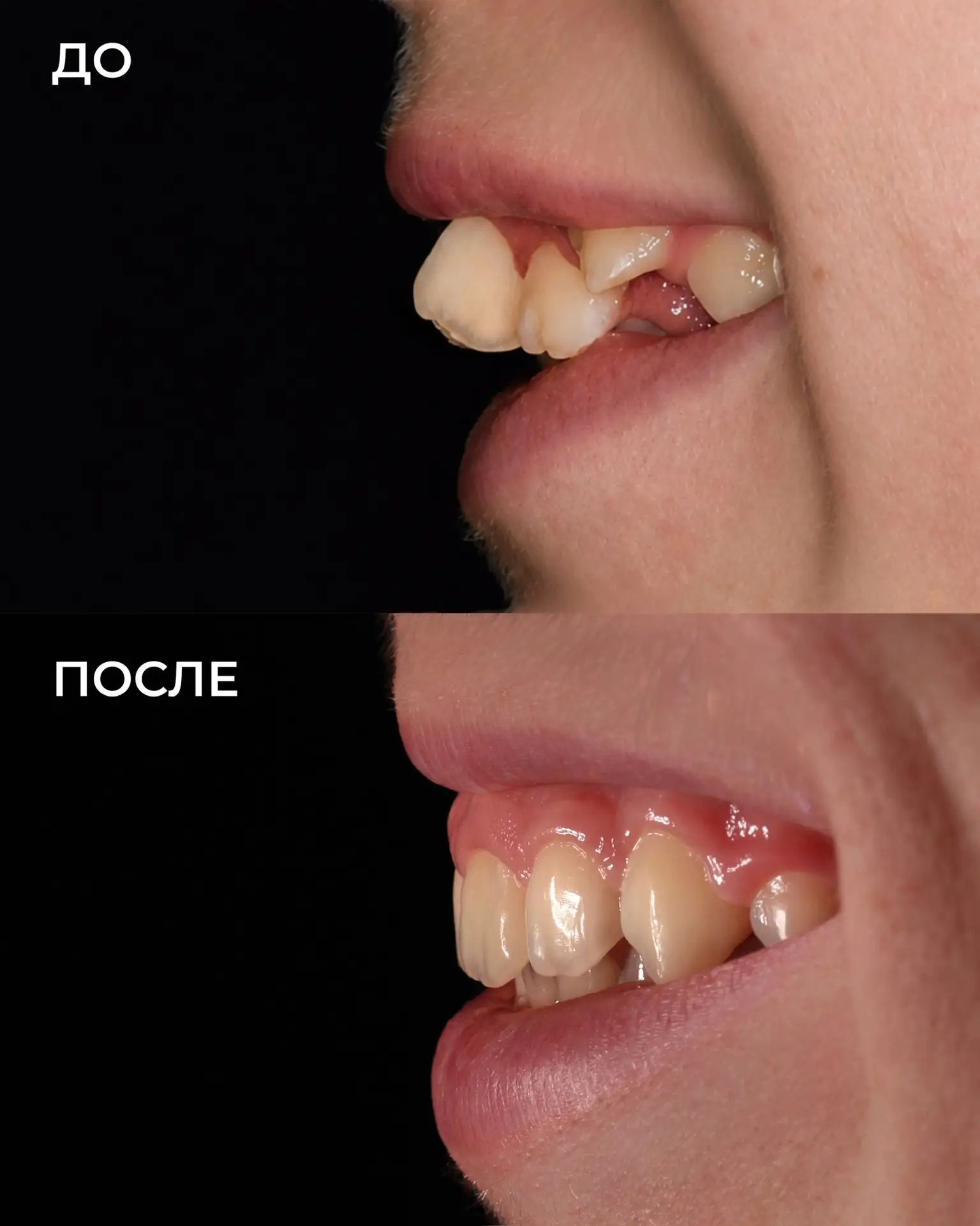 Кейс: ортодонтическое лечение 🌟🦷