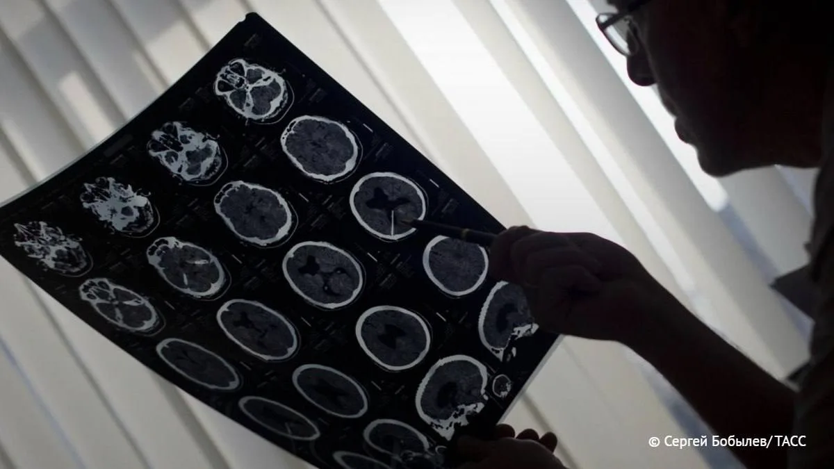 🧠 Проблемы с памятью связали с риском инсульта