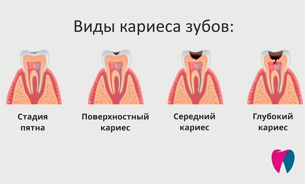 Риск развития кариеса определяется совокупностью нескольких факторов: