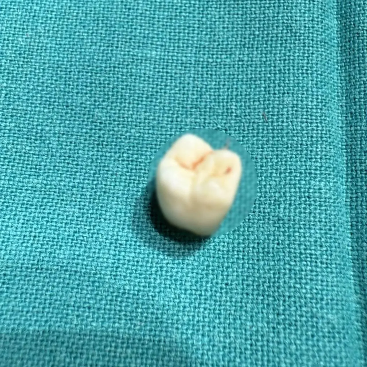 🦷 Зуб из яичника удалили акушеры-гинекологи в Казани 
 
Внутри удаленной кисты, кроме зуба, нашли в