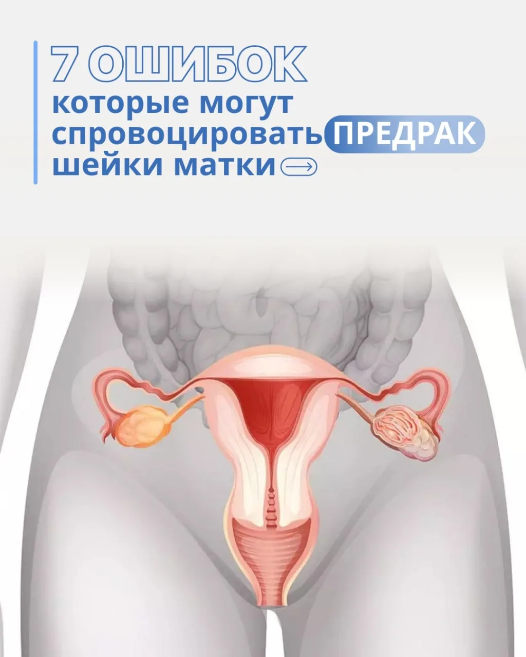 ❌ 7 ошибок, которые могут спровоцировать предрак шейки матки
