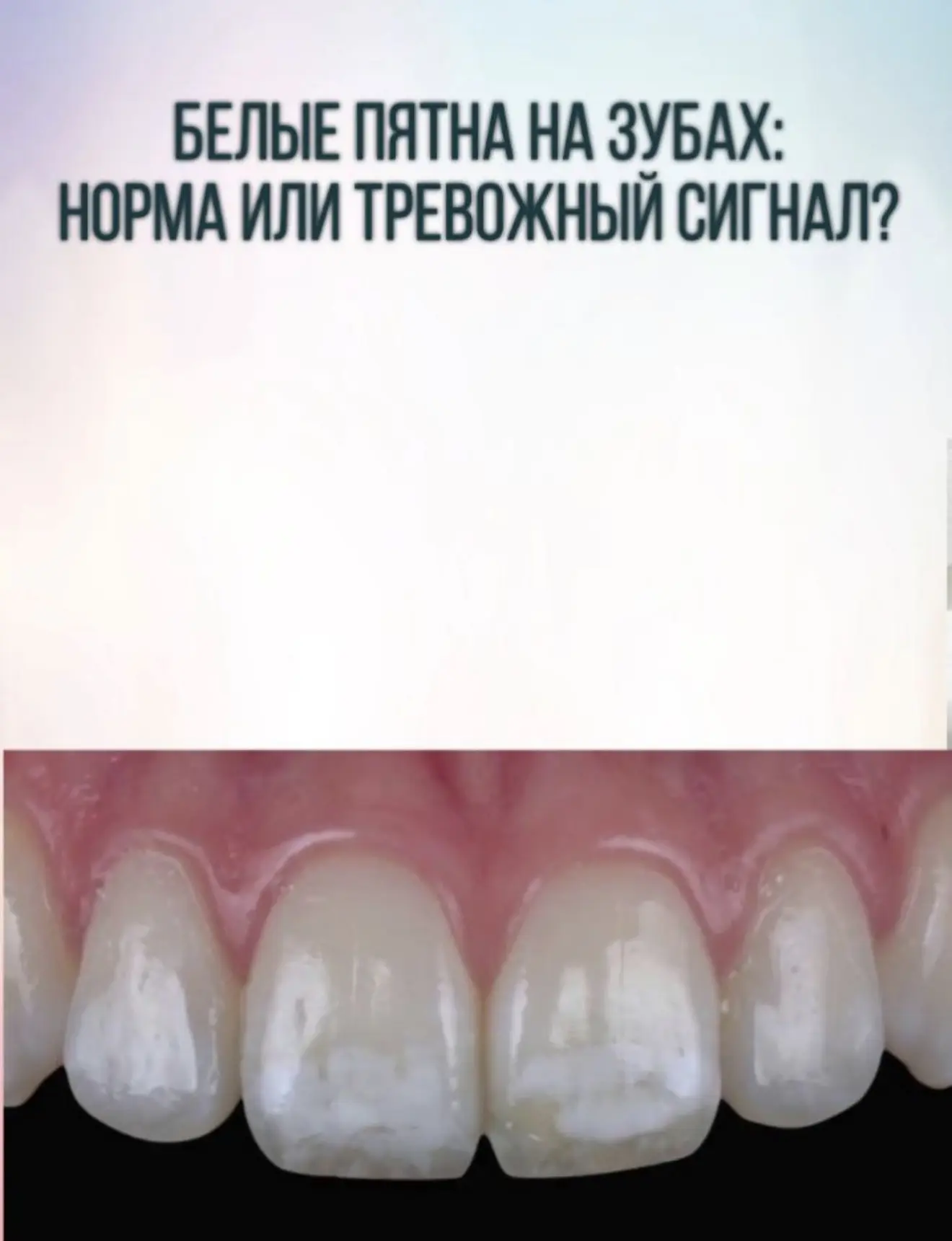 🦷 Белые пятна на зубах: норма или тревожный сигнал? 
 
Если после чистки зубов вы замечаете на эмал