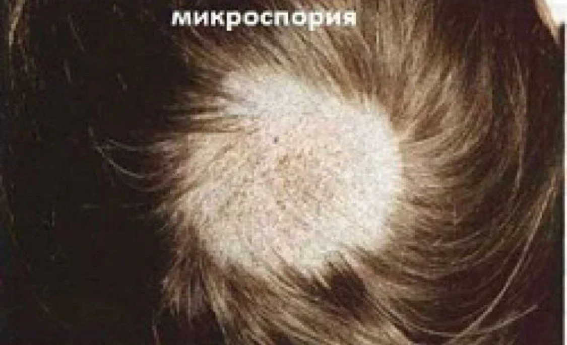 Профилактика микроспории: коротко о главном