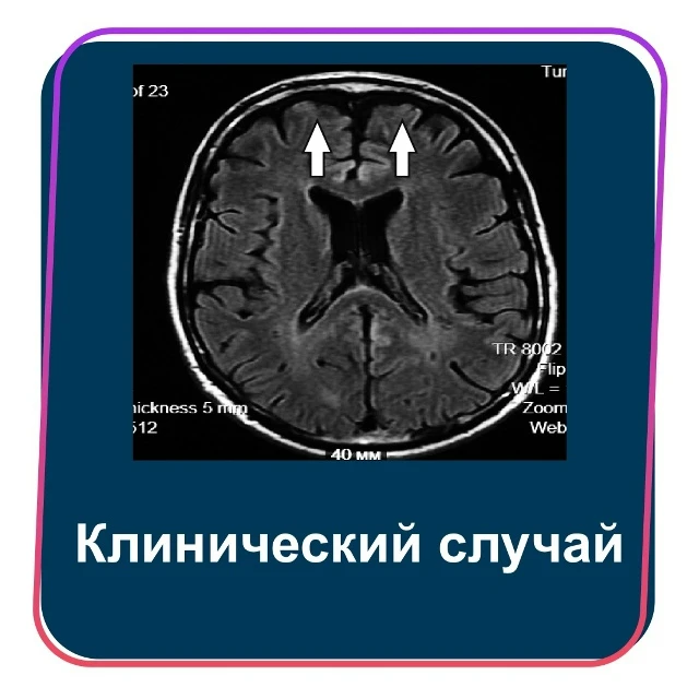 Спорадическая форма болезни Гуам: комплекс БАС — паркинсонизм — деменция
