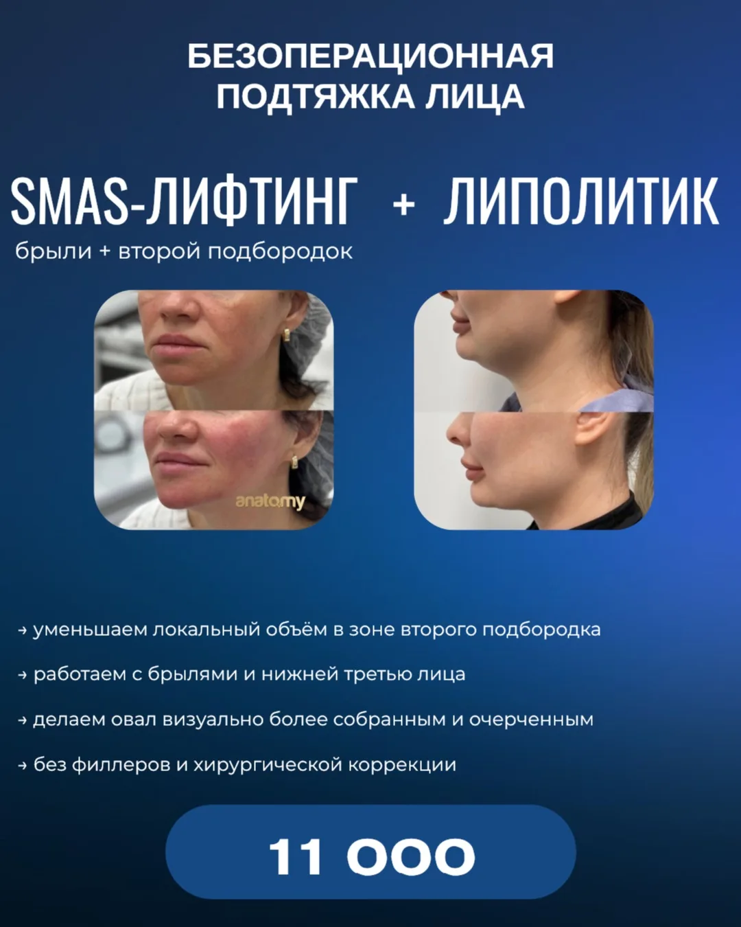 🔥 БЕЗОПЕРАЦИОННАЯ ПОДТЯЖКА ЛИЦА
