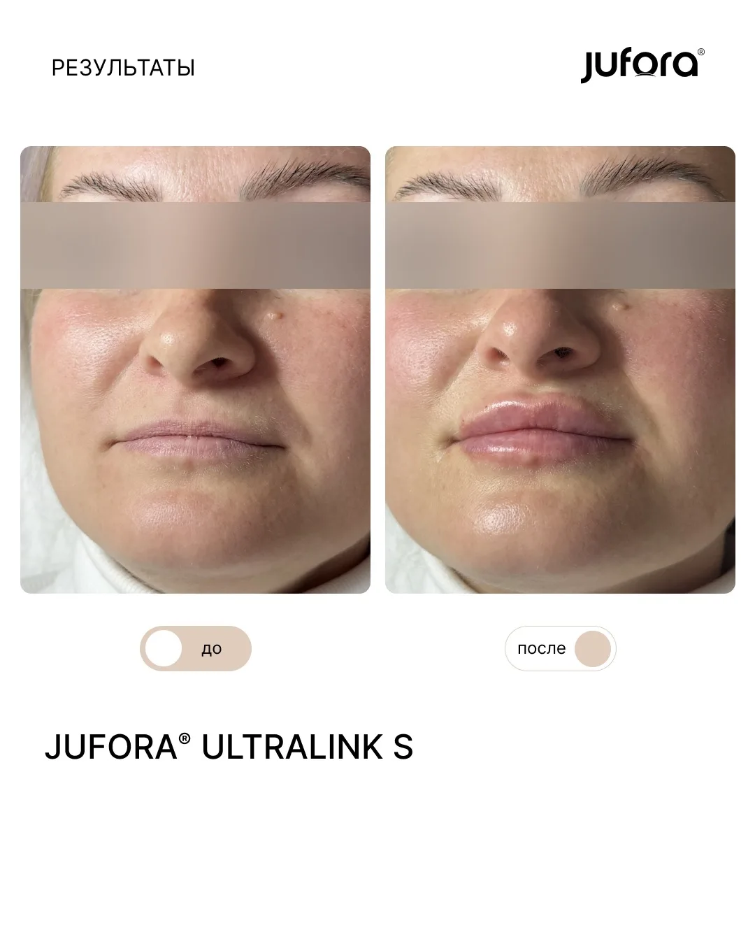 Сезон новых губ продолжается! 💉